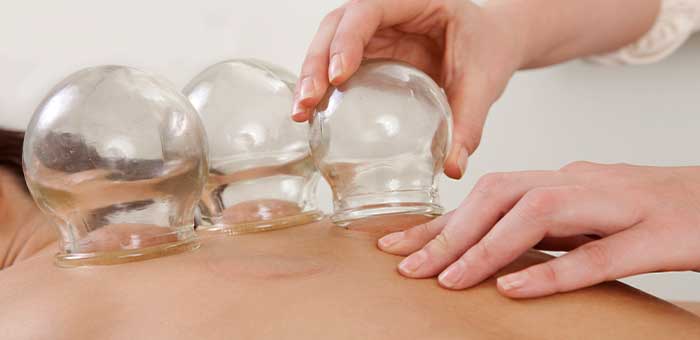 Patient receiving Cupping Therapy in Oakland for pain relief