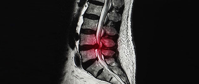 Xray of herniated disc Oakland