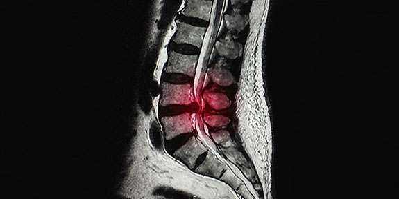 Disc Injury Treatment Oakland