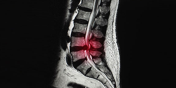 Disc Injury Treatment Oakland